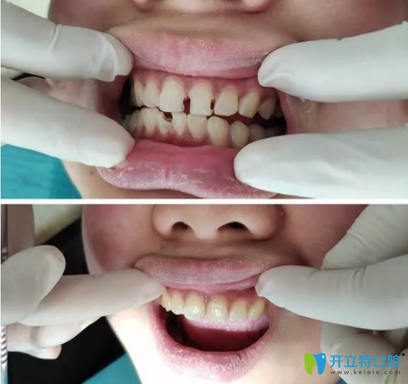 洛陽拜博口腔謝良雄醫(yī)生治療案例前后對比圖