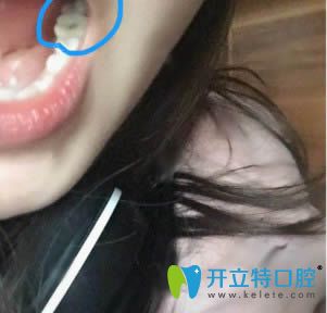 我在泉州維樂口腔做種植牙后的效果圖