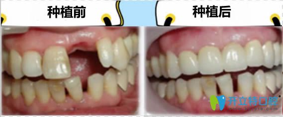 瑞士iti親水種植牙前后對(duì)比效果 瑞士iti親水種植牙前后對(duì)比效果