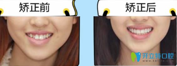 26歲顧客隱適美隱形矯正前后對(duì)比照 26歲顧客隱適美隱形矯正前后對(duì)比照