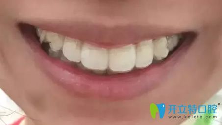 我在北京美萊整形口腔科做牙齒矯正第9個(gè)月 我在北京美萊整形口腔科做牙齒矯正第9個(gè)月