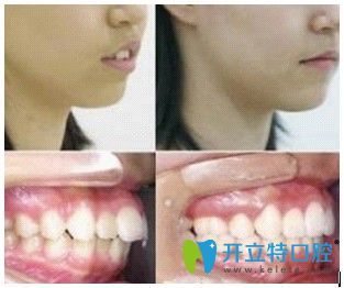 北京美萊口腔宋學(xué)志主任齙牙矯正前后對(duì)比圖