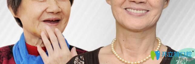 重慶種植牙哪家好？華美牙科全口牙種植案例效果對(duì)比一覽