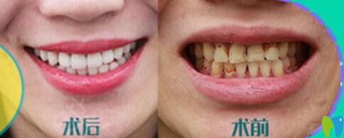 重慶華美牙科靠譜嗎？苗智許超薄瓷貼面修復牙齒案例對比效果公布