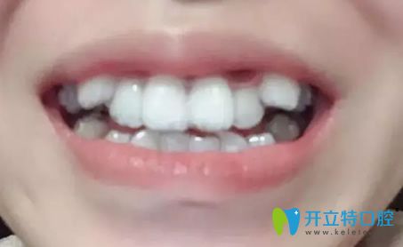 我在北京美萊做隱形牙齒矯正第3個(gè)月 我在北京美萊做隱形牙齒矯正第3個(gè)月