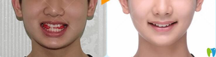 重慶哪家牙科正畸好？華美牙科矯正案例效果來(lái)驗(yàn)證