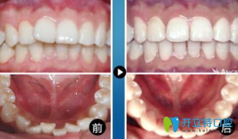 重慶華美口腔王偉好不好？真人牙齒矯正案例效果公布
