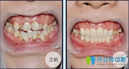 <!--<i data=20240703-sp></i>-->伊萊美牙科李慶云牙齒擁擠矯正前后對比效果