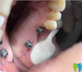 我在太原眾牙口腔做種植牙的術中照