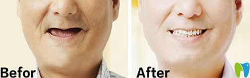 北京京通口腔全口種植牙案例