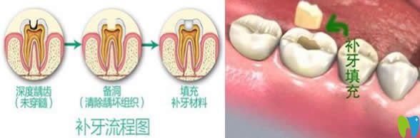有關(guān)補牙會不會越補越爛和千萬不要去補牙的真相大揭秘