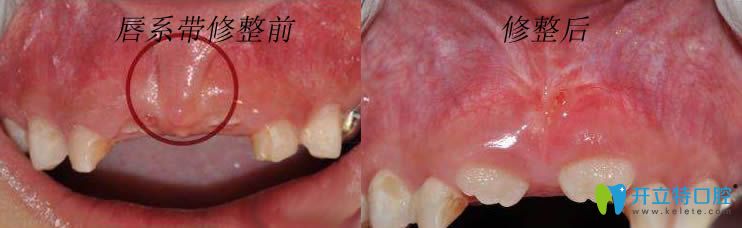 上唇系帶修整術(shù)前后對(duì)比圖