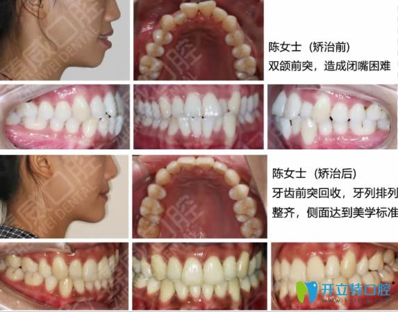 <!--<i data=20240703-sp></i>-->臻威口腔魏東院長雙頜前突矯正前后對比效果