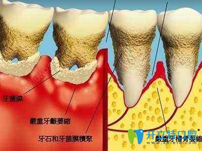 牙齒矯正是否會導(dǎo)致牙齦萎縮
