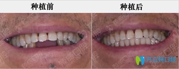 魏東下頜多顆牙缺失即刻種植牙前后對比照