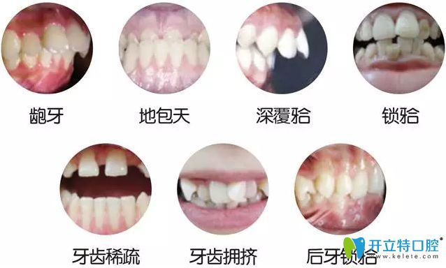 活動翼牙齒矯正的優(yōu)缺點