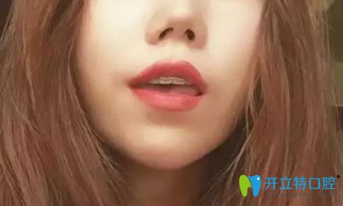 戴半隱形牙套矯正齙牙過程中 戴半隱形牙套矯正齙牙過程中