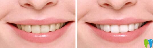 梅州哪家做牙齒美白效果好？愛麗諾牙齒冷光美白效果公布