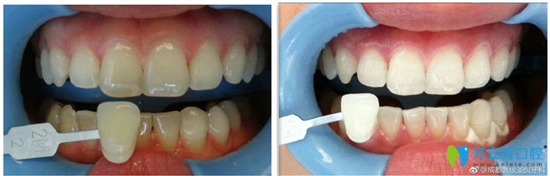 成都圣貝口腔黃祎銘瓷貼面前后變化圖