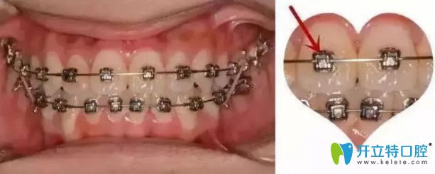 牙齒矯正托槽掉了怎么辦