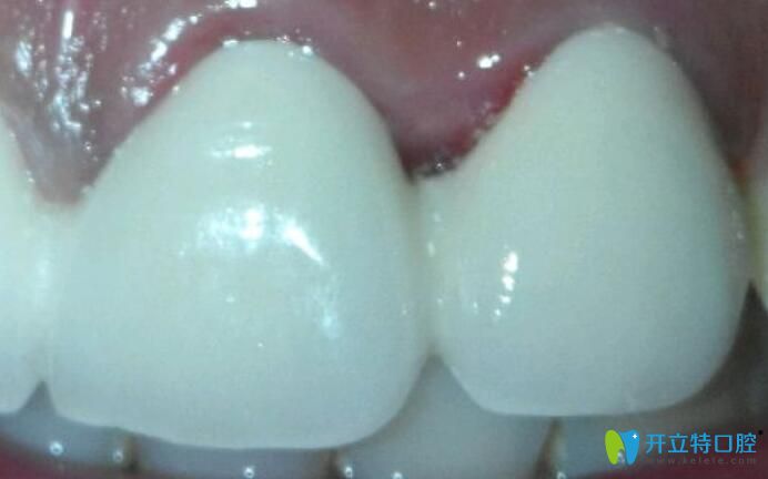 烤瓷牙不密合是什么感覺(jué)