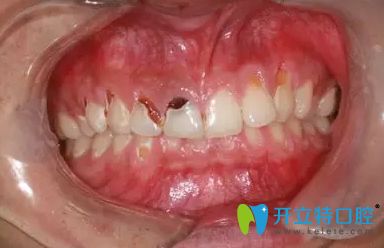 怎么預(yù)防可樂牙