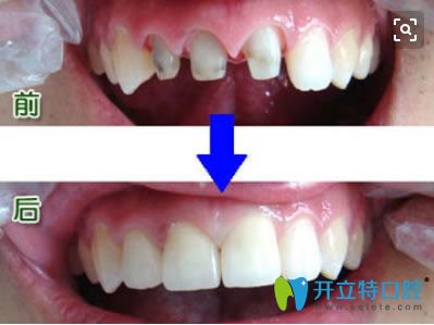 烤瓷牙修復(fù)前后對(duì)比照片