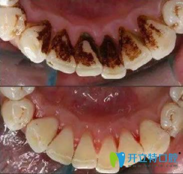 長(zhǎng)春欣雅口腔李國民醫(yī)生洗牙前后對(duì)比效果