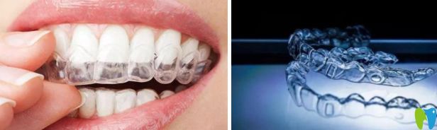 正畸必看摘戴隱形牙套的過(guò)程圖解及隱形牙套怎么清潔