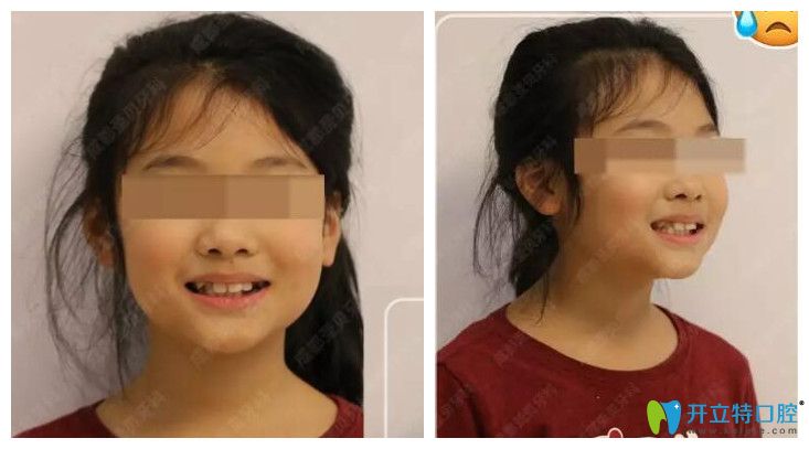 小孩輕微齙牙、個(gè)別牙反頜在成都圣貝口腔做正畸案例效果