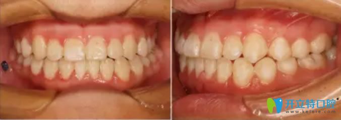 <!--<i data=20240703-sp></i>-->口腔陸千程醫(yī)生安氏Ⅲ類錯頜矯正后案例效果圖