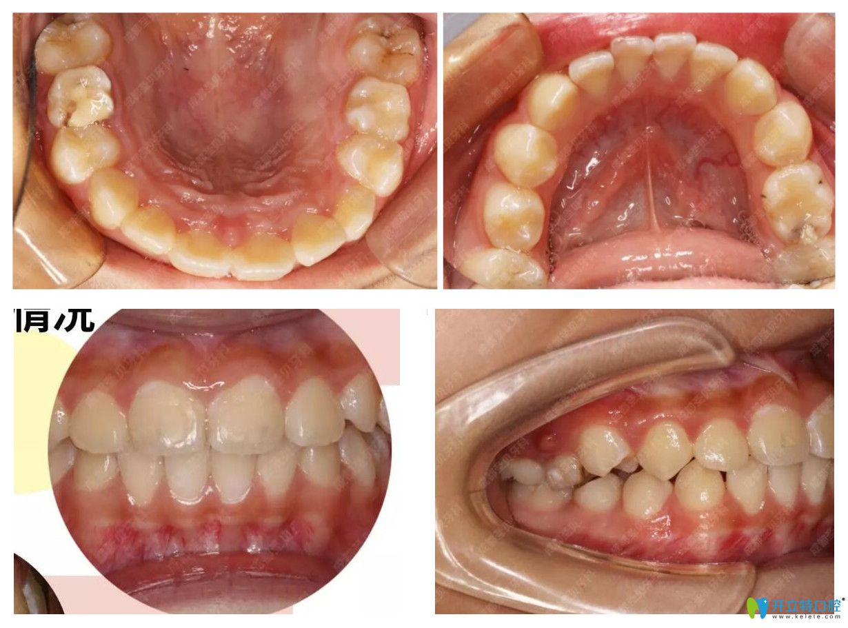 圣貝口腔正畸后口腔照 圣貝口腔正畸后口腔照