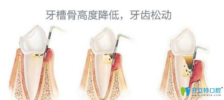 牙齒松動是什么原因造成的