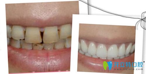 保定合眾口腔修復前后對比圖