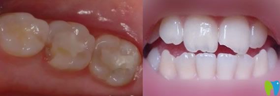 顧客問后牙缺了一小塊怎么辦以及牙齒缺了一塊需要補牙嗎?