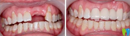 即刻種植牙前后對(duì)比圖 即刻種植牙前后對(duì)比圖
