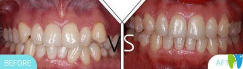 凱樂口腔牙齒矯正前后對比圖