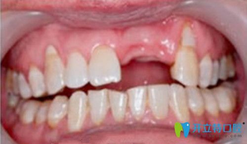 口腔種植前的牙齒 口腔種植前的牙齒