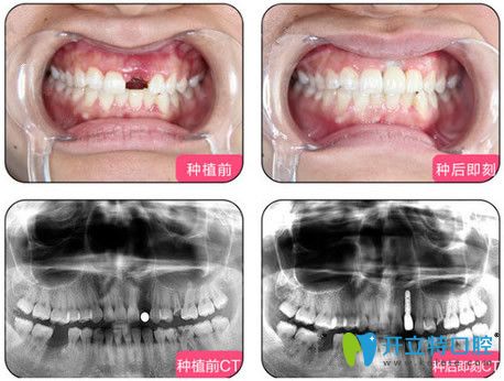 烏魯木齊凱樂口腔單顆種植牙效果圖
