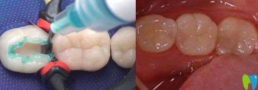 后牙缺失一小塊補(bǔ)牙效果