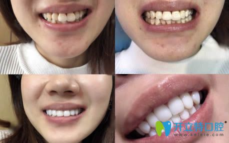 我在沈陽康貝佳口腔做瓷貼面的前后對(duì)比照