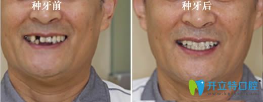 60歲老人半口種植牙前后對(duì)比案例