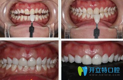 全瓷貼面牙齒前后對比圖