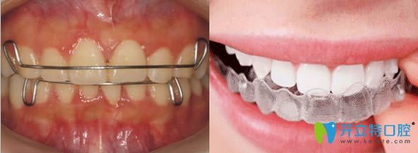 牙齒矯正后保持器圖