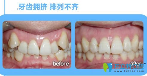 深圳諾德文梁醫(yī)生牙齒擁擠矯正前后對(duì)比效果