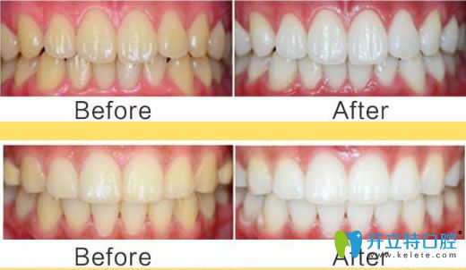 諾德齒科成人洗牙前后對(duì)比效果