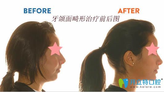 牙頜面畸形矯治前后對(duì)比圖