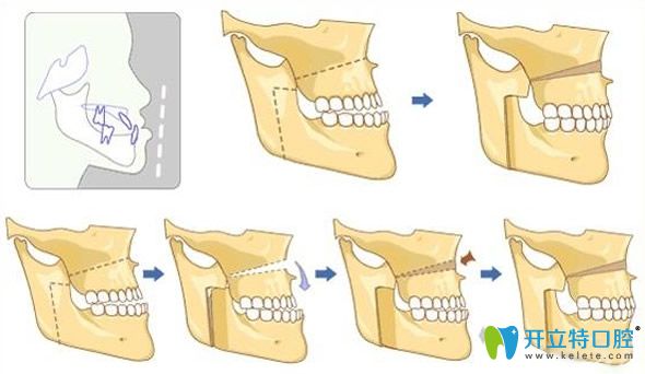 地包天牙齒矯正移動(dòng)過(guò)程圖