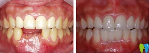 北極星口腔種植牙前后對(duì)比圖