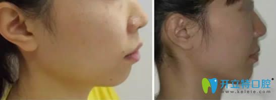 深覆合矯正后臉型變化對(duì)比效果圖